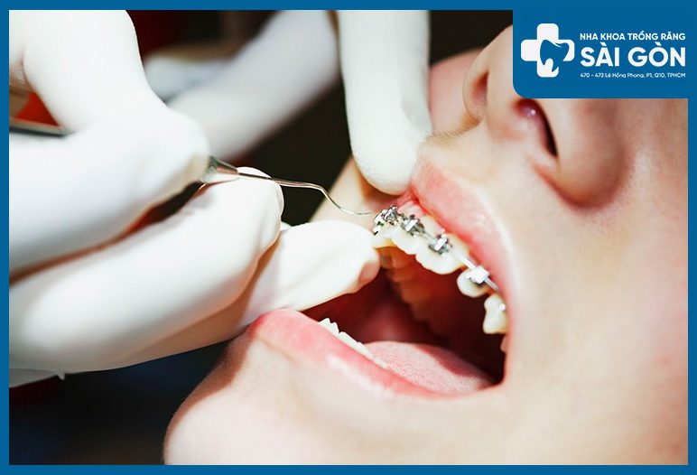 Nha khoa nhận Tháo mắc cài và Kiểm tra Niềng Răng