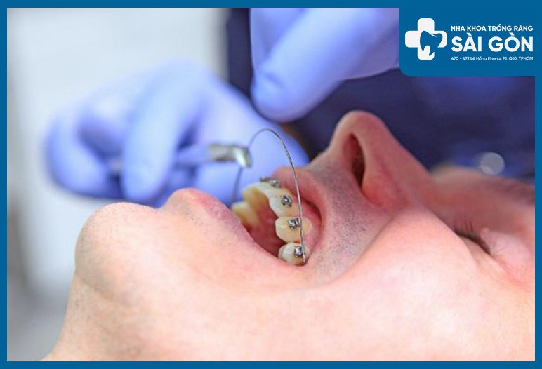 Nha khoa nhận tháo mắc cài và kiểm tra niềng răng