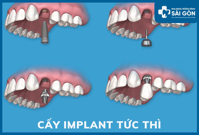 cấy ghép implant tức thì