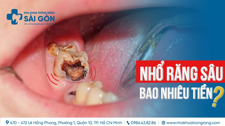 nhổ răng sâu bao nhiêu tiền