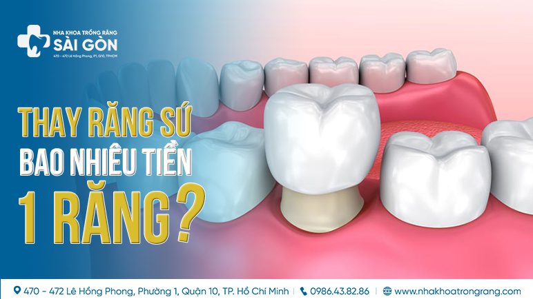 thay răng sứ bao nhiêu tiền