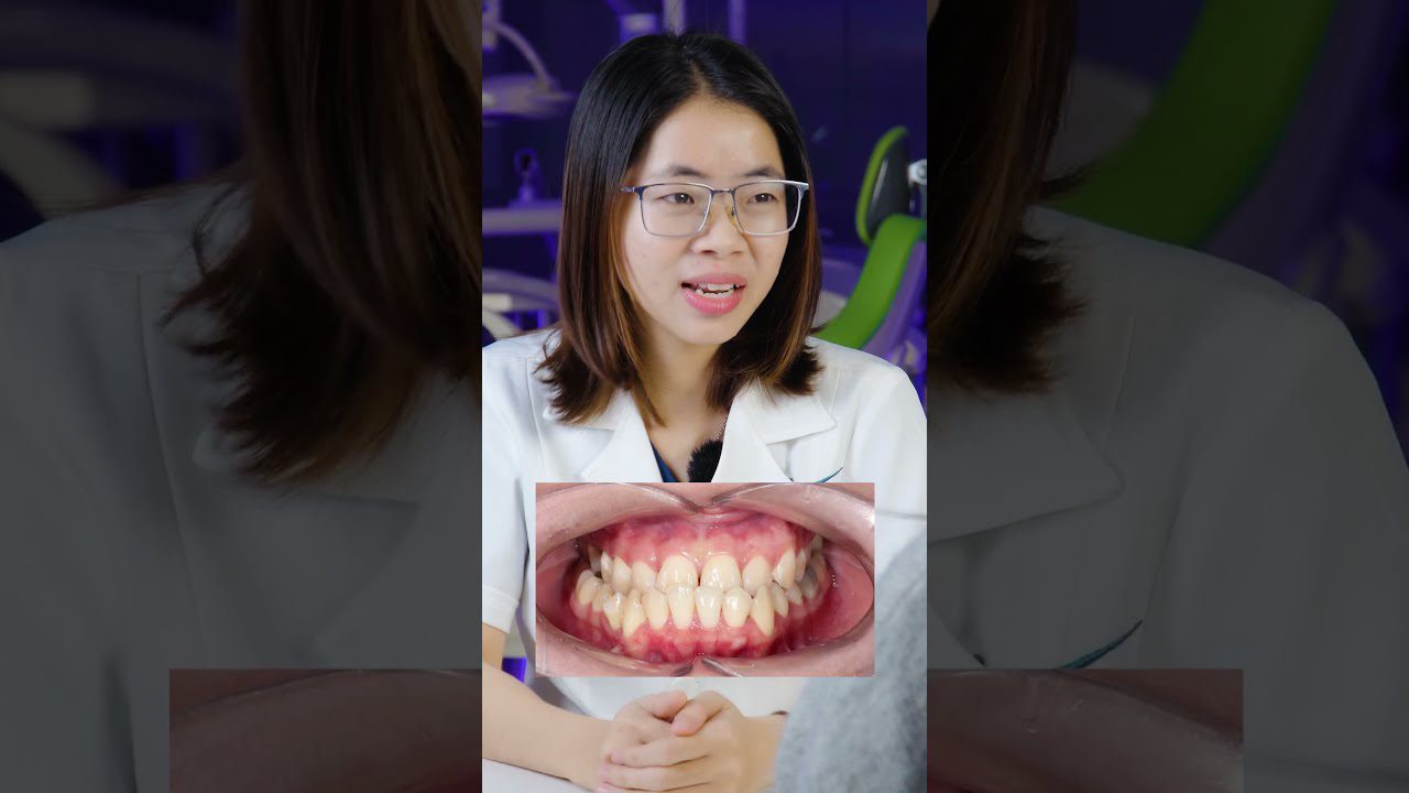 Chi Phí Niềng Răng Trong Suốt Tất Cả Những Gì Bạn Cần Biết