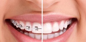 nieng invisalign tat ca nhung gi ban can biet 64eea9f15cbe8