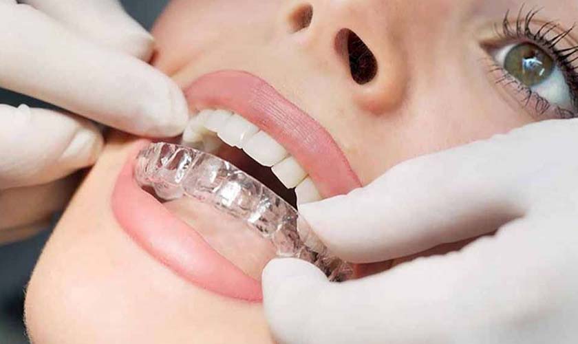 Niềng Invisalign và tất cả những gì bạn cần biết