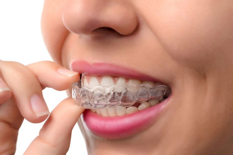 Niềng Invisalign và tất cả những gì bạn cần biết