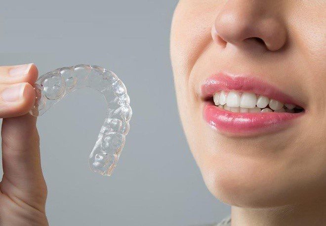 Niềng răng trong suốt Invisalign Sự lựa chọn thông minh cho nụ cười hoàn hảo