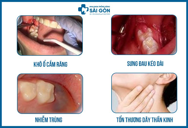 biến chứng nhổ răng khôn