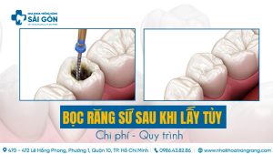 bọc răng sứ sau khi lấy tủy