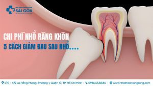 chi phí nhổ răng khôn