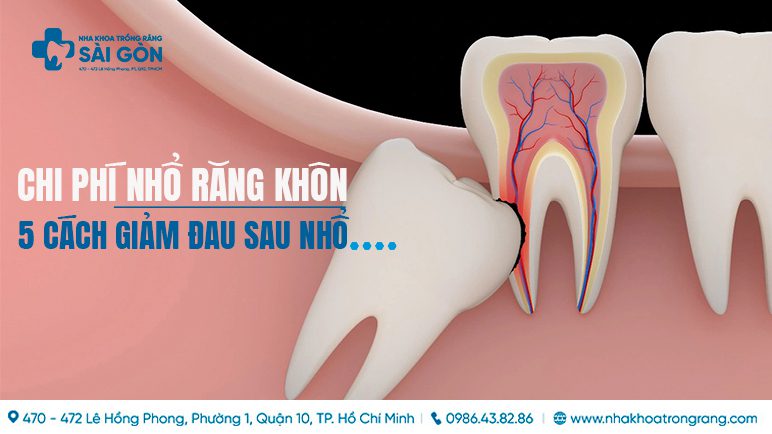 chi phí nhổ răng khôn