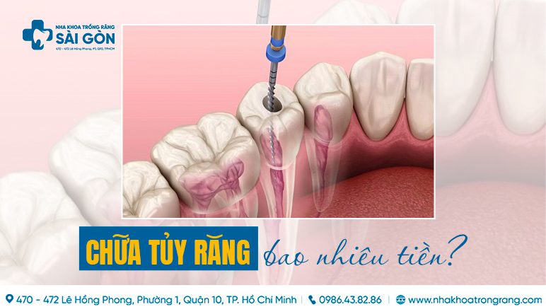 chữa tủy răng bao nhiêu tiền