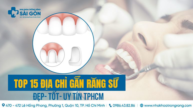 địa chỉ gắn răng sứ uy tín