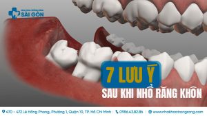 lưu ý sau khi nhổ răng khôn