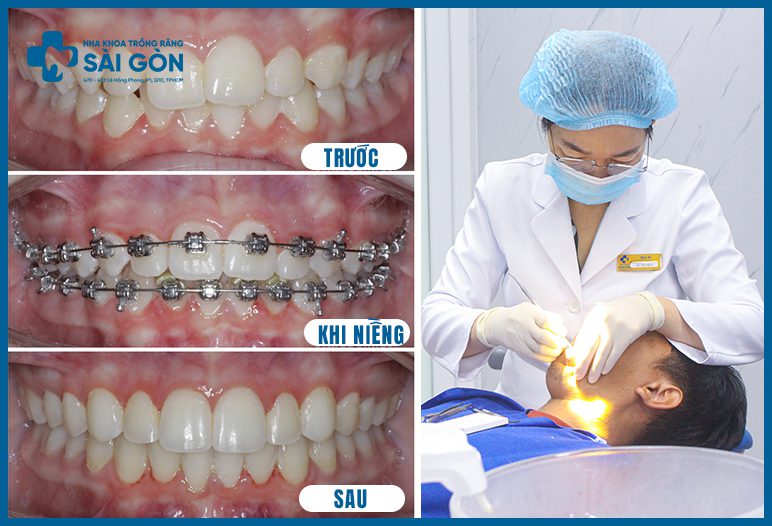 hình ảnh niềng răng trước sau