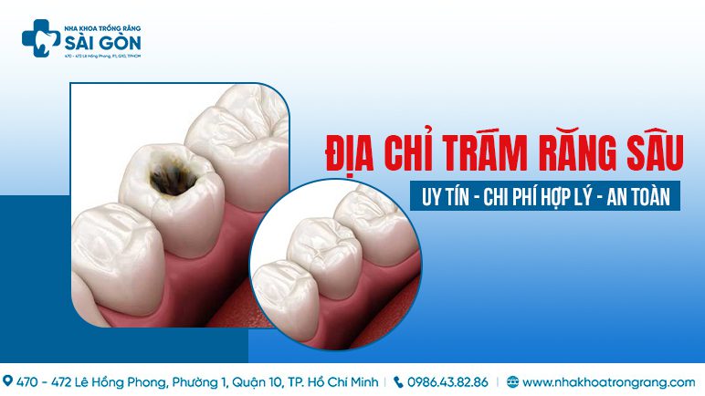 dia chi tram rang sau uy tin địa chỉ trám răng sâu uy tín