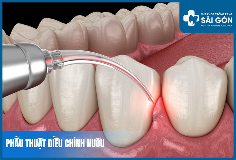 phau thuat nuou phẫu thuật chỉnh hình nướu
