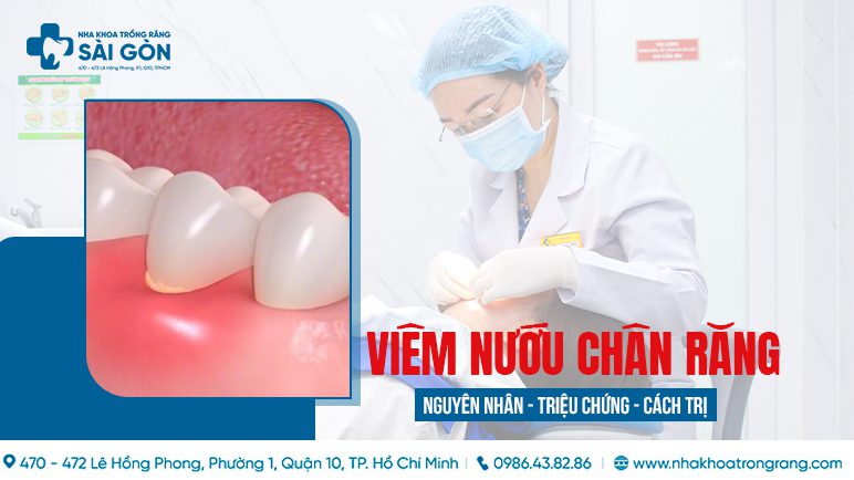 viem nuou chan rang viêm nướu chân răng