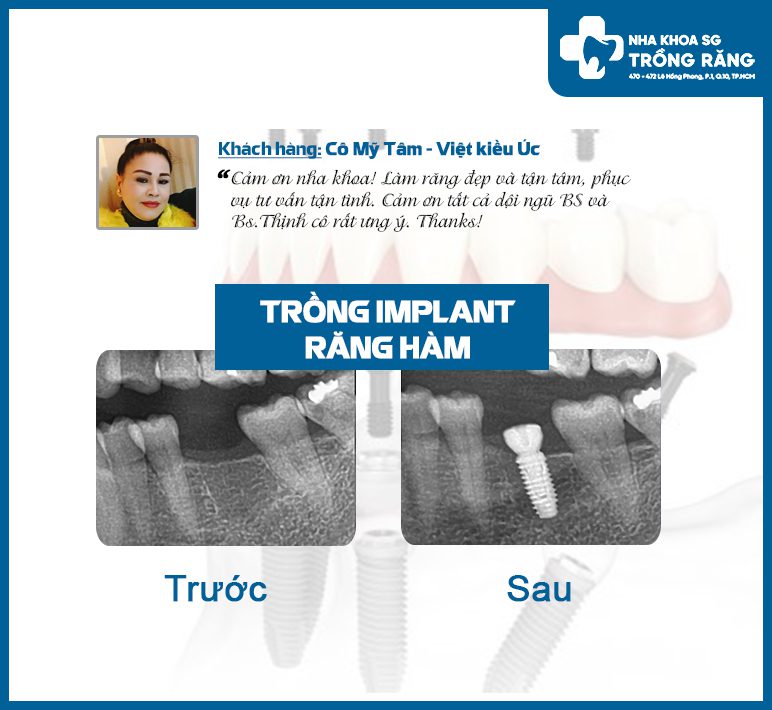 khach hang Viet kieu da lam rang tai Nha Khoa Trong Rang Sai Gon