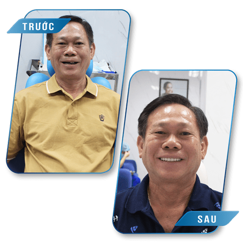trong rang implant hinh anh truoc sau 3