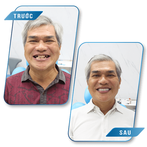 trong rang implant hinh anh truoc sau 4