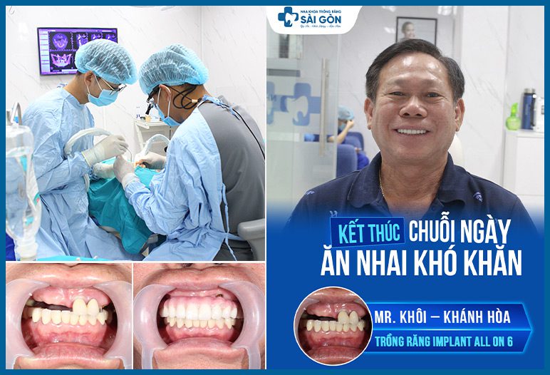 trồng răng implant hàm trên