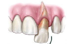 Chan thuong rang do tai nan