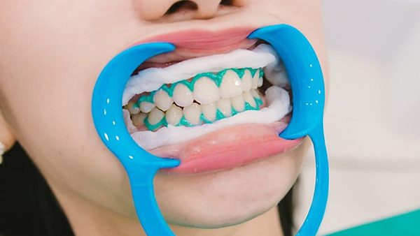 Tien hanh cach ly moi nuou rang