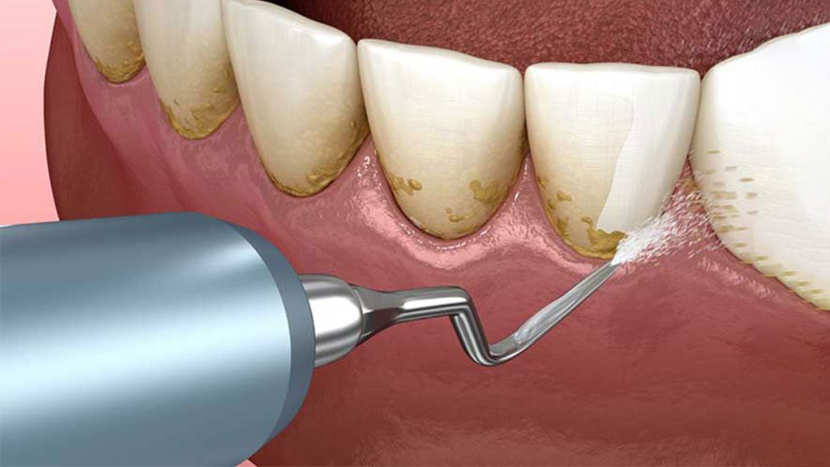 Ve sinh rang mieng lay dau rang tam Ve sinh rang mieng lay dau rang tam