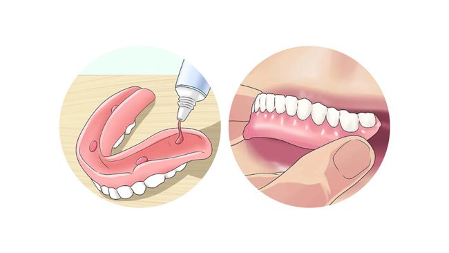 dieu chinh rang thao lap