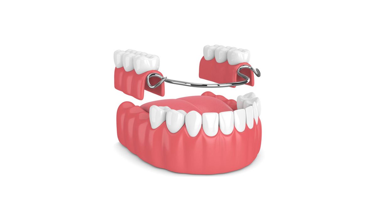 dinh rang vao ham gia