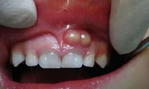 mu trang o loi phia duoi chan rang