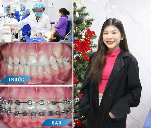 niềng-răng-1