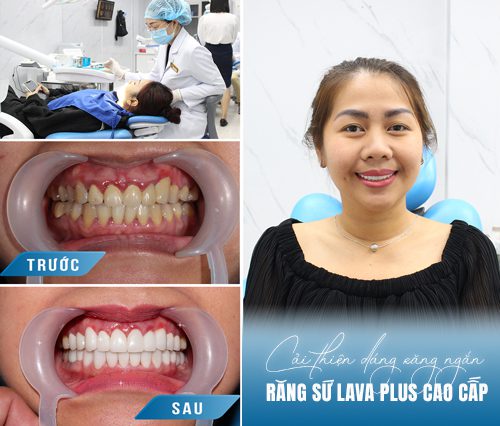 Địa chỉ nha khoa uy tín tphcm về răng sứ thẩm mỹ