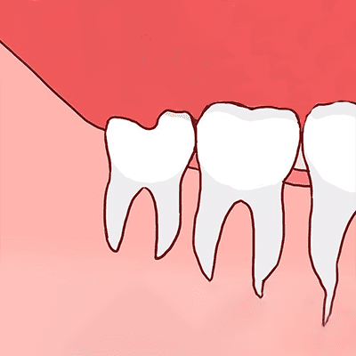 truong hop chi dinh nho rang khon 3 truong hop chi dinh nho rang khon 3