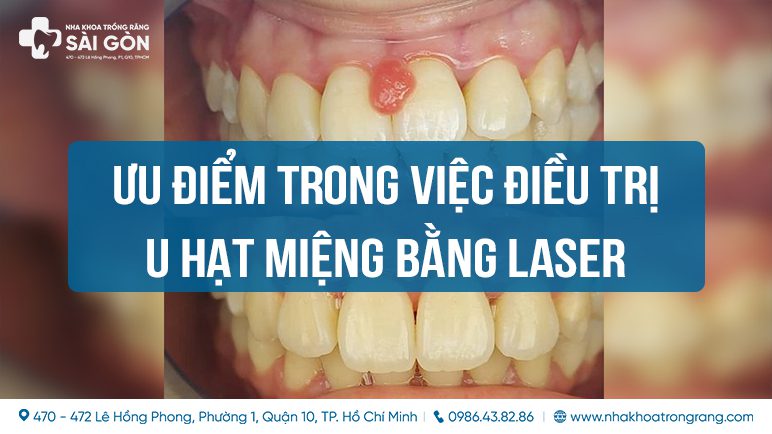 uu diem trong viec dieu tri u hat mieng granulomas bang laser