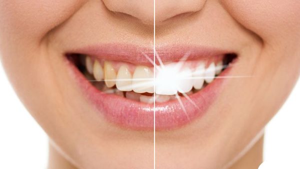 ve sinh rang mieng sau dieu tri