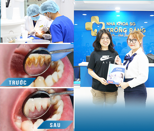 cao-voi-rang-hinh-anh-truoc-sau-1