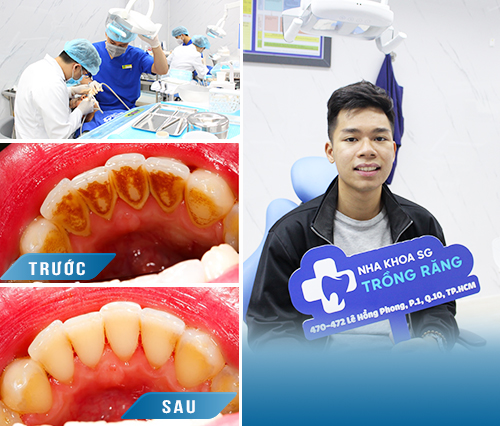 cao-voi-rang-hinh-anh-truoc-sau-2