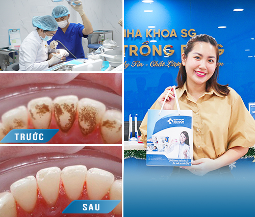 cao-voi-rang-hinh-anh-truoc-sau