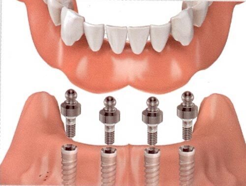 cay ghep implant 659f6ce156412
