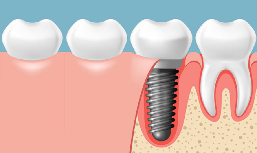 Địa chỉ trồng răng Implant TPHCM uy tín, chất lượng