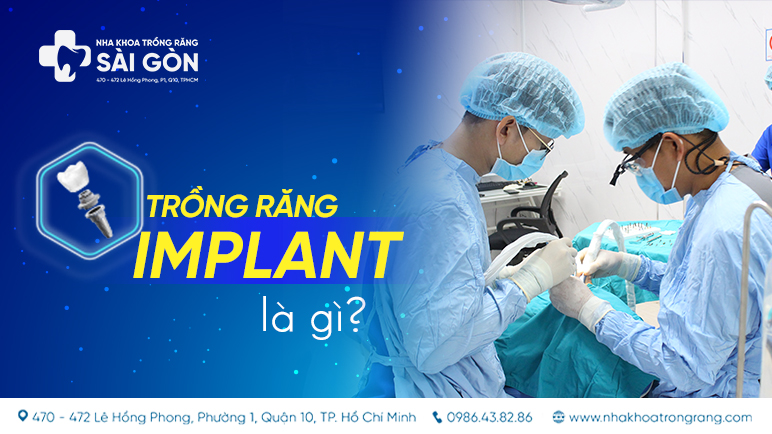 Trồng răng implant mất bao lâu? | Thời gian cấy ghép implant là bao lâu?