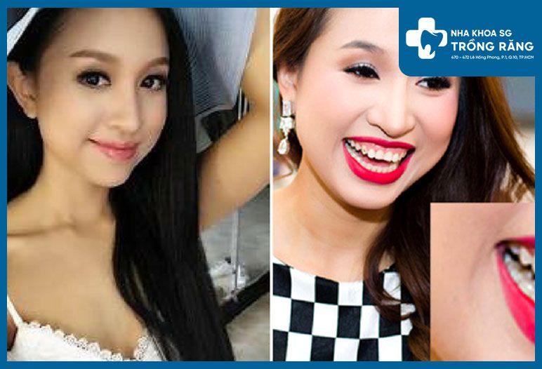 Nên cười nhe răng hay cười mỉm khi chụp ảnh?