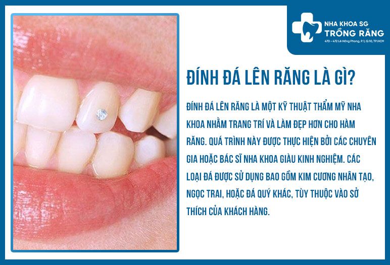 Đính đá răng là gì?