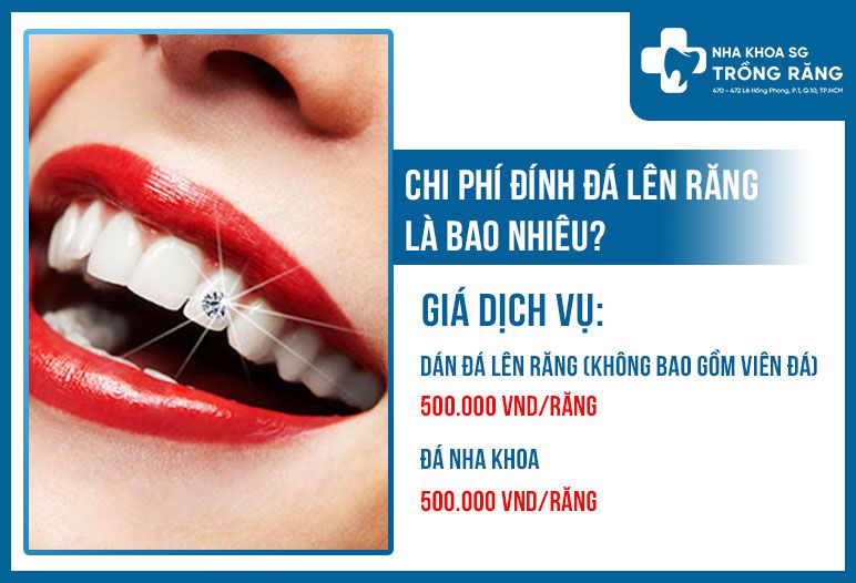 Chi phí đính đá răng dao động từ 500.000 - 1.000.000 vnd/răng