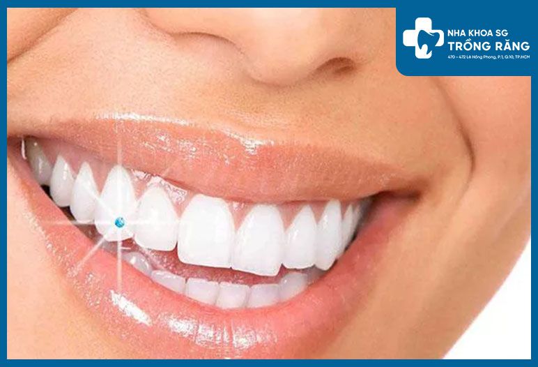 Không nên nghiến hoặc ngậm răng quá mạnh vì có thể gây ra áp lực lên viên đá