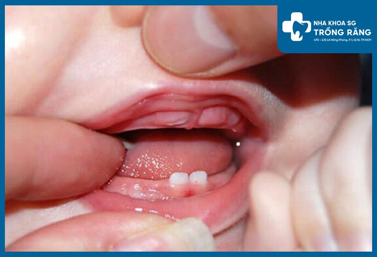 hinh anh loi tre moc rang cua 1 2