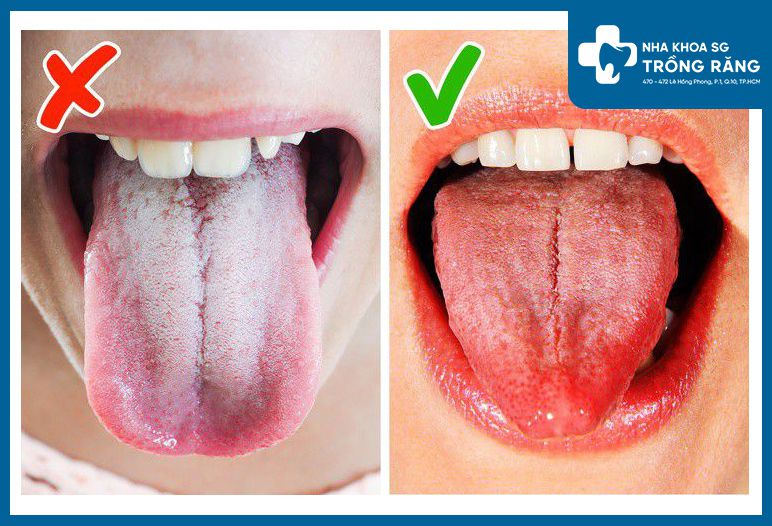 hinh anh luoi bi benh 4