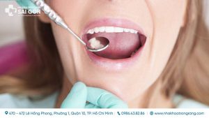 hinh anh luoi bi benh thumb