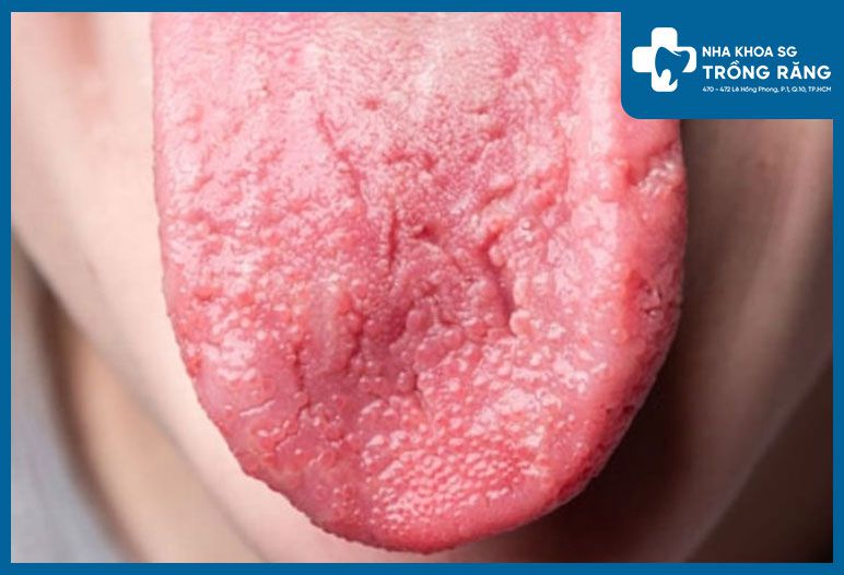 Gai lưỡi bị sưng viêm, nổi hạt và ửng đỏ